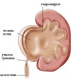 Гидронефроз