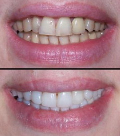 Керамические и композитные виниры для зубов 
