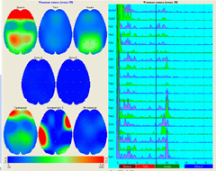 Электроэнцефалография головного мозга