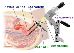 Схема проведения кольпоскопии