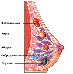 Лечение фиброзной мастопатии