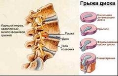 Грыжа позвоночника: методы лечения