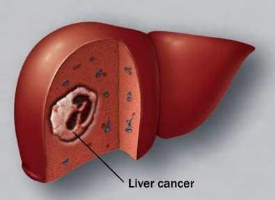 Рак печени