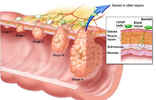 Развитие рака толстой кишки