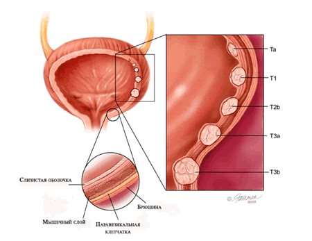 Рак мочевого пузыря