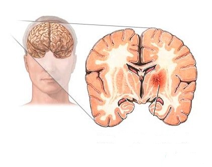 Симптомы рака головного мозга