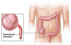 Воспаление аппендицита