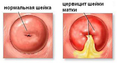 Цервицит