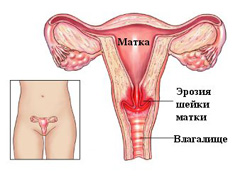 Эрозия шейки матки