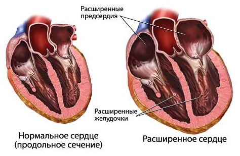 Хроническая сердечная недостаточность