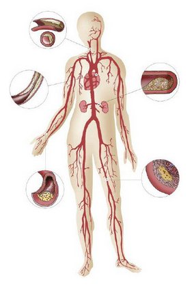 Атеросклероз сосудов