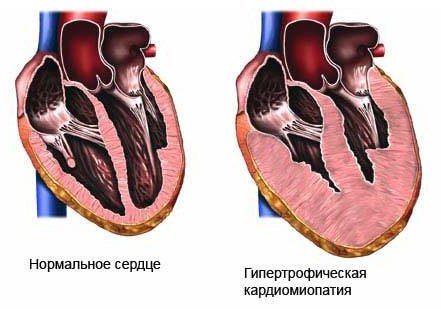 Симптомы кардиомиопатии