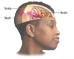 Контузия головного мозга