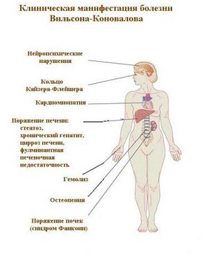 Клиническая манифестация болезни Вильсона-Коновалова