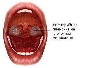 Симптомы дифтерии