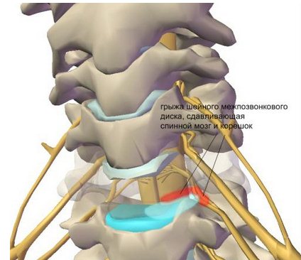 Остеохондроз шейного отдела позвоночника