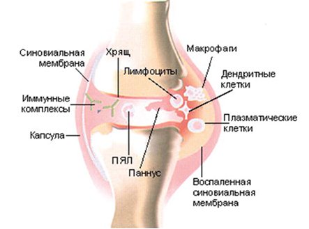 Симптомы ревматоидного артрита