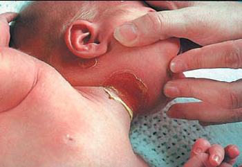 Симптомы листериоза у маленького ребенка