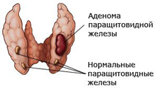 Первичный гиперпаратиреоз