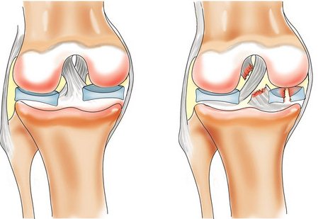 Разрыв мениска