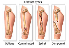Виды переломов костей