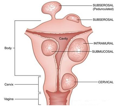 Prichiny endometrita