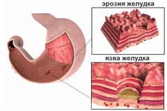 Причины эрозии желудка