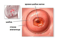 Симптомы эрозии шейки матки