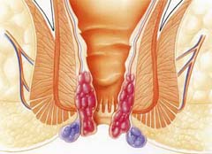 Симптомы геморроя