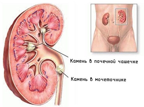 Симптомы мочекаменной болезни