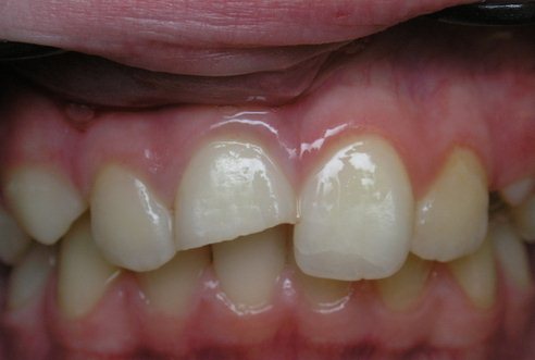 Травмы зубов у детей и взрослых
