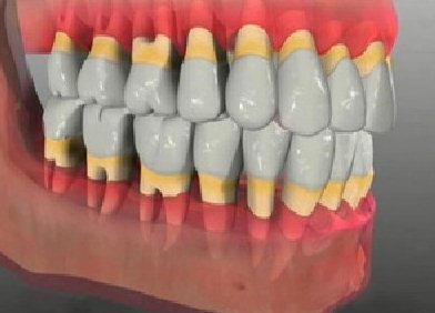 Оголение корней зубов при пародонтозе