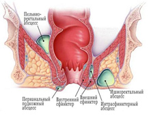 Причины свища прямой кишки