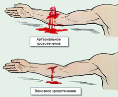 Виды кровотечений