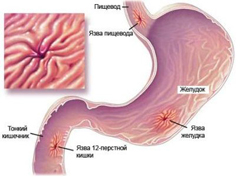 Язва желудка
