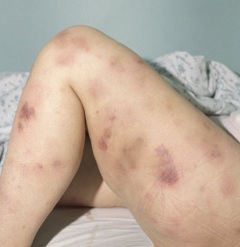 Бледность кожных покровов - один из симптомов лимфолейкоза
