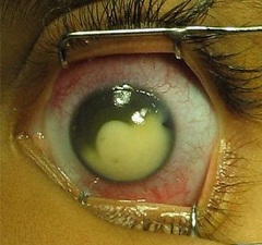 Первый симптом болезни - покраснение глаза