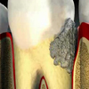 Как образуется налет на зубах