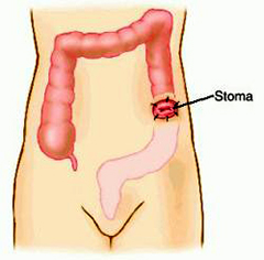 Основные правила ухода за стомой 