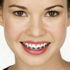 Выравнивание зубов: установка брекетов
