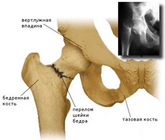 Перелом бедренной кости