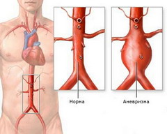 Аневризма брюшной аорты 