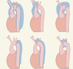 Типы расслаивающейся аневризмы дуги аорты