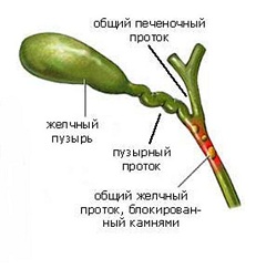 Желчнокаменная болезнь - образование камней в желчных протоках или пузыре