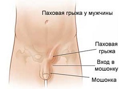 Паховая грыжа у мужчины - одна из причин болей в лобковой кости