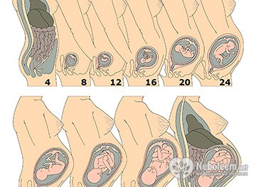 Медикаментозный аборт - на каком сроке можно проводить