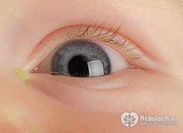 Конъюнктивит - воспаление глаза у ребенка