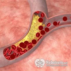 Холестириновая диета помогает снизить уровень холестерина в крови
