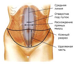 Результат абдоминопластики живота