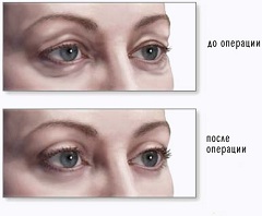 Глаза женщины до и после блефаропластики